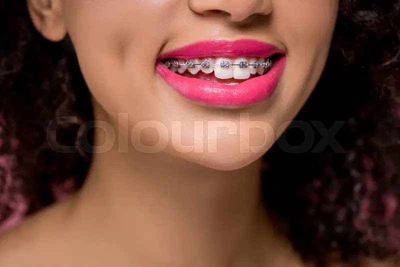 Braces (Teeth Alignment)